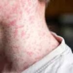 Measles surge in Unakoti triggers red alert