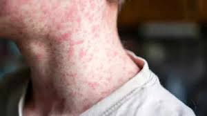 Measles surge in Unakoti triggers red alert